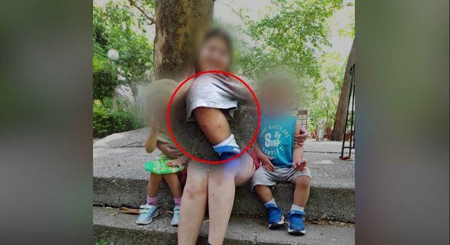 Λάρισα: Φωτογραφίες ντοκουμέντο με τα σημάδια από τα καψίματα στα κορμιά των δύο παιδιών
